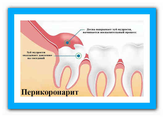 Как уменьшить боль в зубе